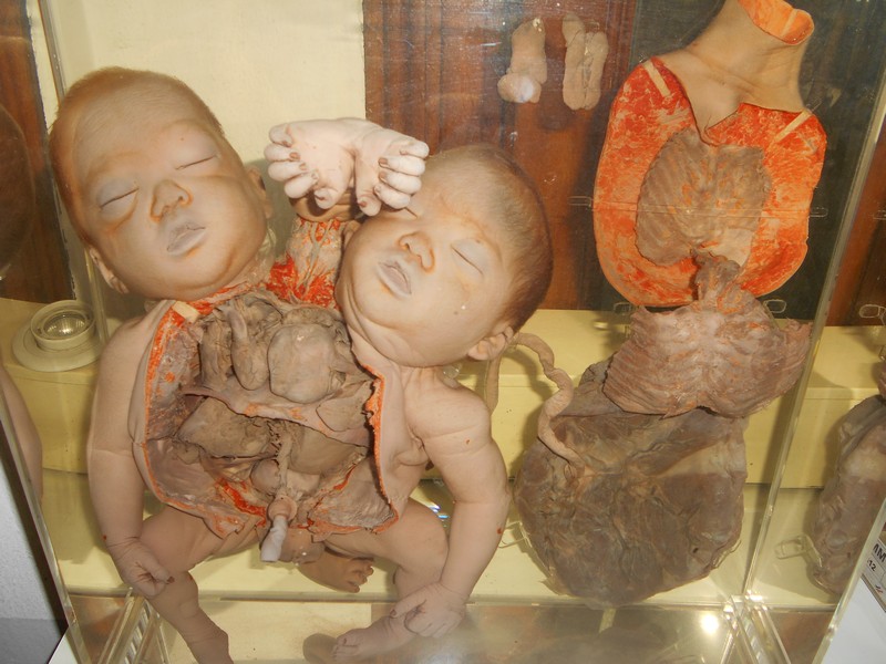 I don’t even remember how I found Siriraj Medical Museum as a place to visit in Bangkok, but I’m glad I did. This was the creepiest museum.