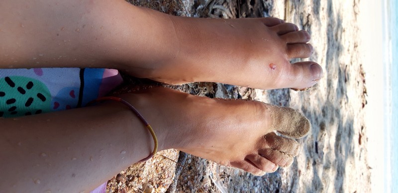 So, I was very unfortunate to be stung by a stingray while snorkeling in Thailand on Poda island and about to leave the water after snorkeling.